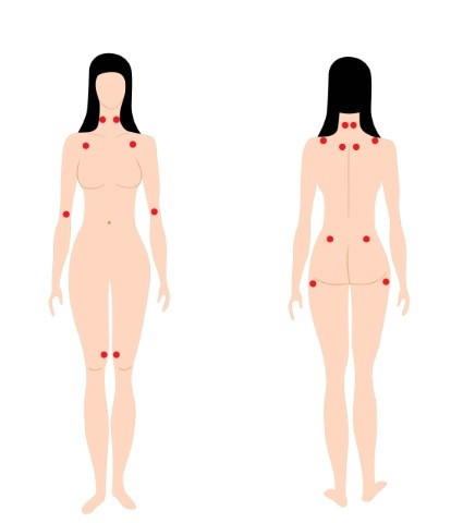 Fibromiyalji nedir Fibromiyalji belirtileri nelerdir