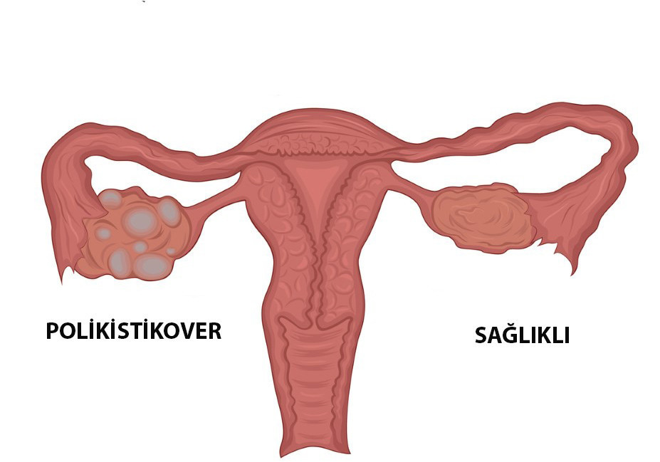 Yaşam tarzınızı değiştirin, polikistik overi yenin