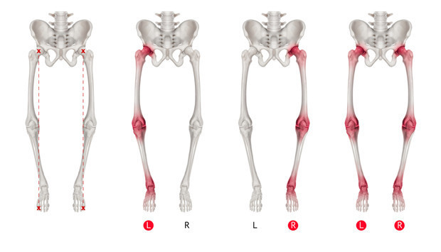 Raşitizm nedir Raşitizm nedenleri, belirtileri, tedavisi