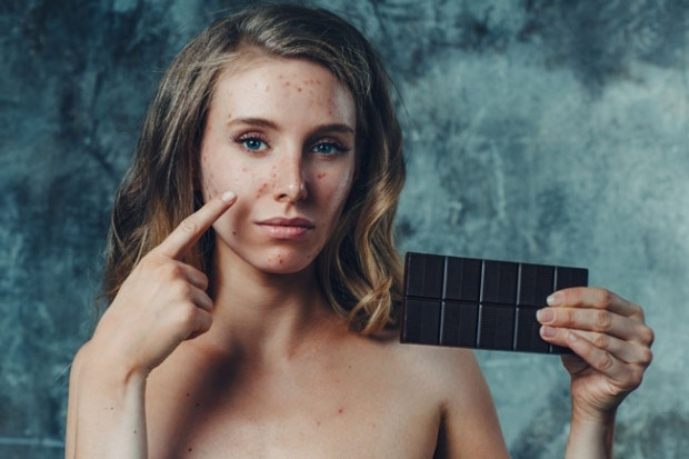 Çikolata alerjisi Çikolata alerjisi