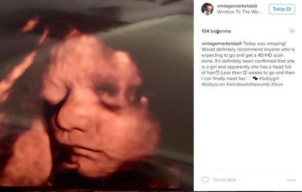 Bebeklerinin ultrason görüntülerini Instagramdan paylaşan anne adayları