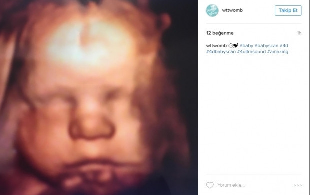 Bebeklerinin ultrason görüntülerini Instagramdan paylaşan anne adayları