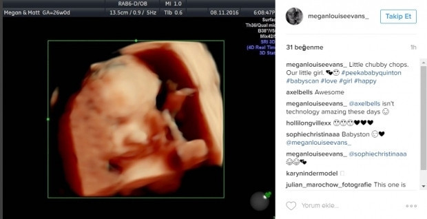 Bebeklerinin ultrason görüntülerini Instagramdan paylaşan anne adayları