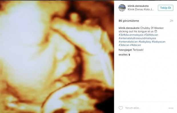 Bebeklerinin ultrason görüntülerini Instagramdan paylaşan anne adayları