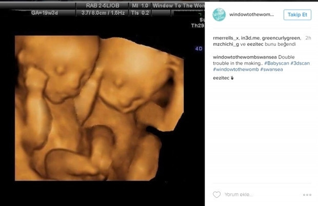 Bebeklerinin ultrason görüntülerini Instagramdan paylaşan anne adayları