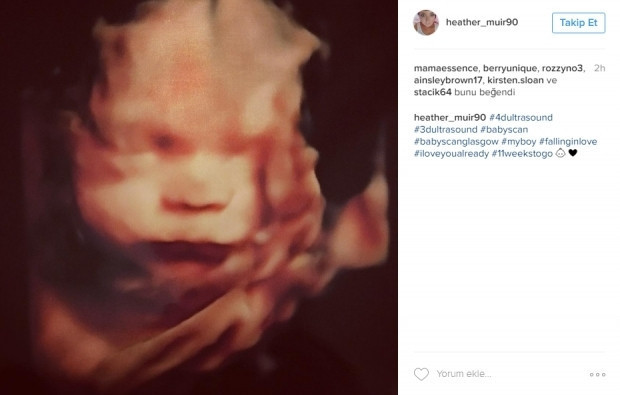 Bebeklerinin ultrason görüntülerini Instagramdan paylaşan anne adayları