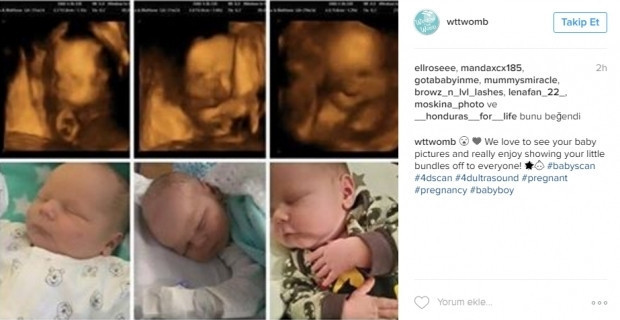 Bebeklerinin ultrason görüntülerini Instagramdan paylaşan anne adayları