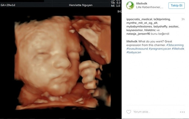 Bebeklerinin ultrason görüntülerini Instagramdan paylaşan anne adayları