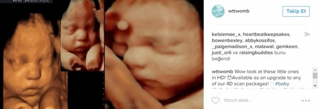 Bebeklerinin ultrason görüntülerini Instagramdan paylaşan anne adayları