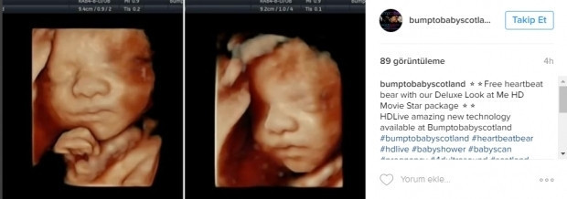 Bebeklerinin ultrason görüntülerini Instagramdan paylaşan anne adayları
