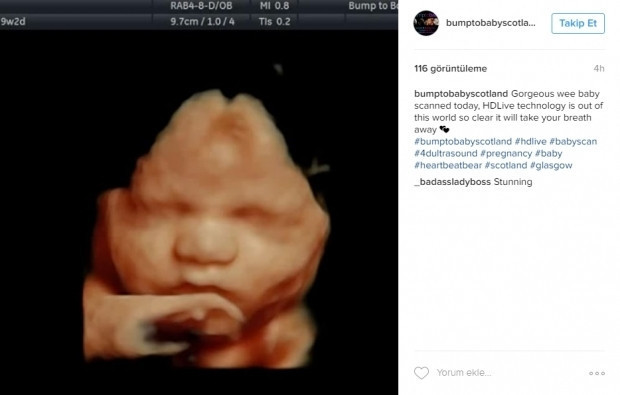 Bebeklerinin ultrason görüntülerini Instagramdan paylaşan anne adayları