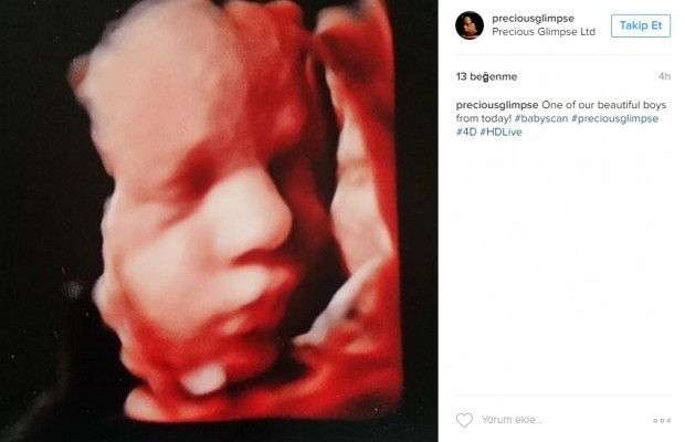 Bebeklerinin ultrason görüntülerini Instagramdan paylaşan anne adayları