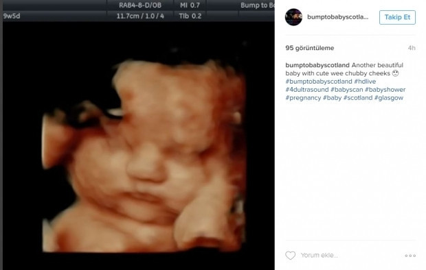 Bebeklerinin ultrason görüntülerini Instagramdan paylaşan anne adayları