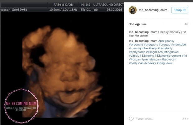 Bebeklerinin ultrason görüntülerini Instagramdan paylaşan anne adayları