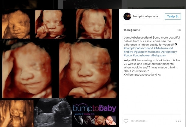 Bebeklerinin ultrason görüntülerini Instagramdan paylaşan anne adayları