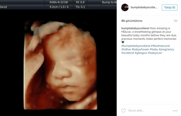 Bebeklerinin ultrason görüntülerini Instagramdan paylaşan anne adayları