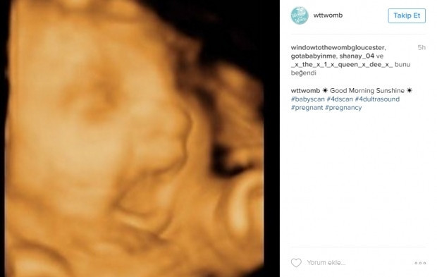Bebeklerinin ultrason görüntülerini Instagramdan paylaşan anne adayları