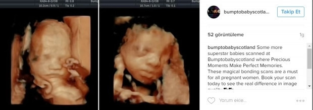 Bebeklerinin ultrason görüntülerini Instagramdan paylaşan anne adayları