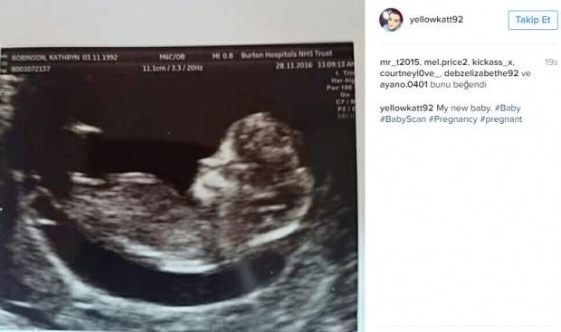 Bebeklerinin ultrason görüntülerini Instagramdan paylaşan anne adayları