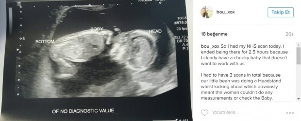 Bebeklerinin ultrason görüntülerini Instagramdan paylaşan anne adayları