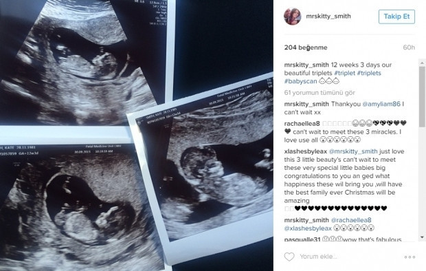 Bebeklerinin ultrason görüntülerini Instagramdan paylaşan anne adayları