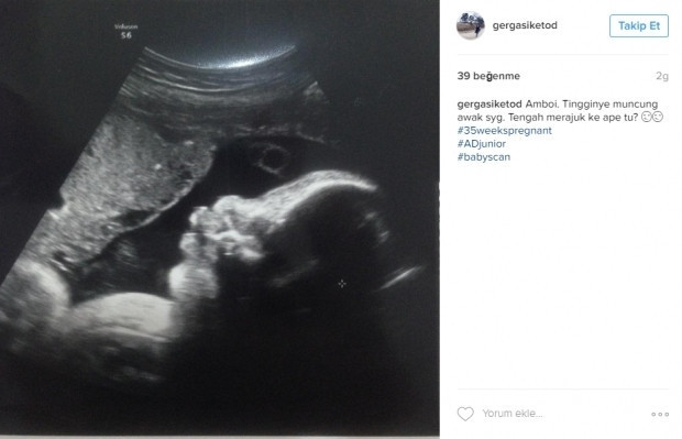 Bebeklerinin ultrason görüntülerini Instagramdan paylaşan anne adayları