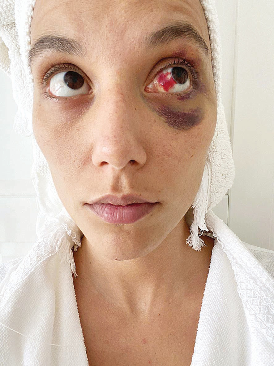 Son dakika haberi... Deniz Bulutsuzun fotoğrafı şok etti: Ozan Güven beni böyle dövdü