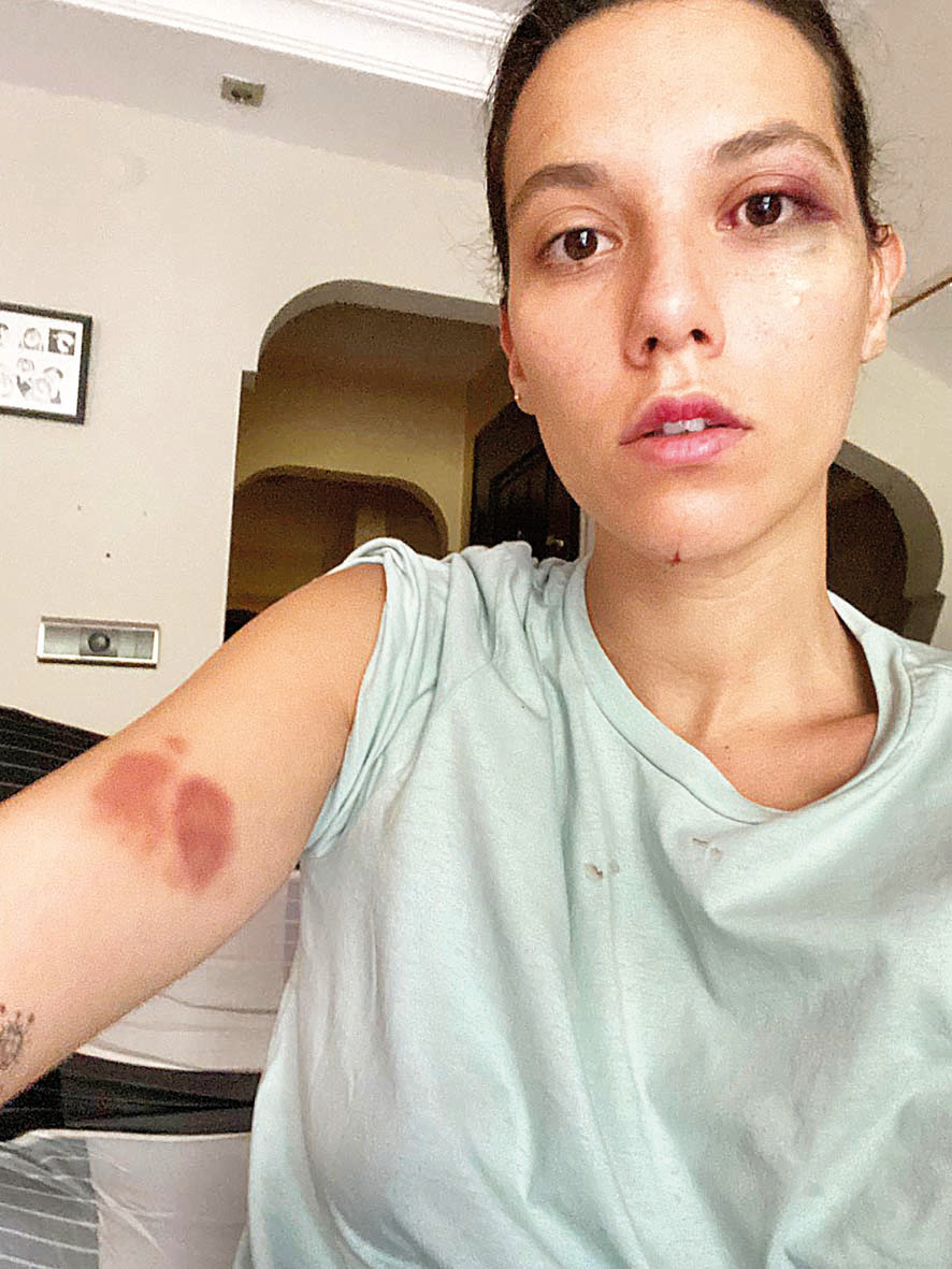 Son dakika haberi... Deniz Bulutsuzun fotoğrafı şok etti: Ozan Güven beni böyle dövdü