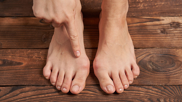 Halluks Valgus hastalığı nedir ve neden olur Tedavi yöntemleri nelerdir