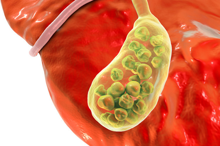 Safra kesesinde en çok taş ve polip görülüyor