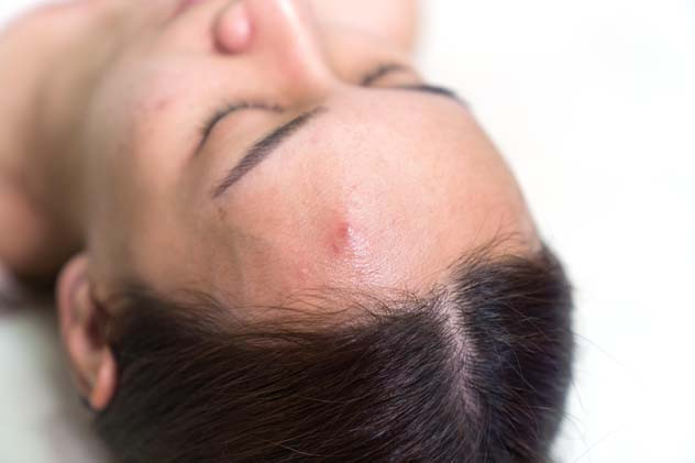 Ekran Işığı Akneyi Tetikliyor