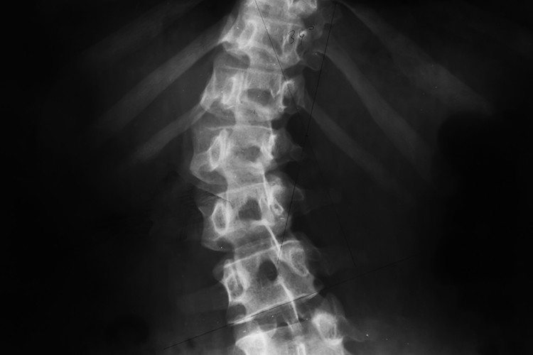 Her 10 çocuktan 1inde görülüyor... Erken teşhisi hayati önem taşıyor Her 10 çocuktan 1inde görülüyor... Erken teşhisi hayati önem taşıyor