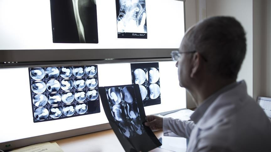 Epilepsi nedir Epilepsi nöbeti ne demek