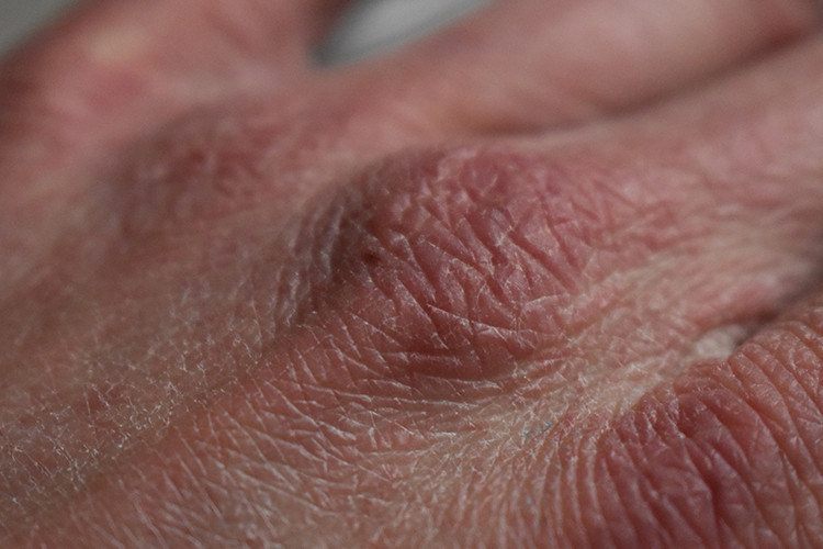 Eksikliği pek çok hastalığı tetikliyor... Kansızlık en sık kadınlarda görülüyor