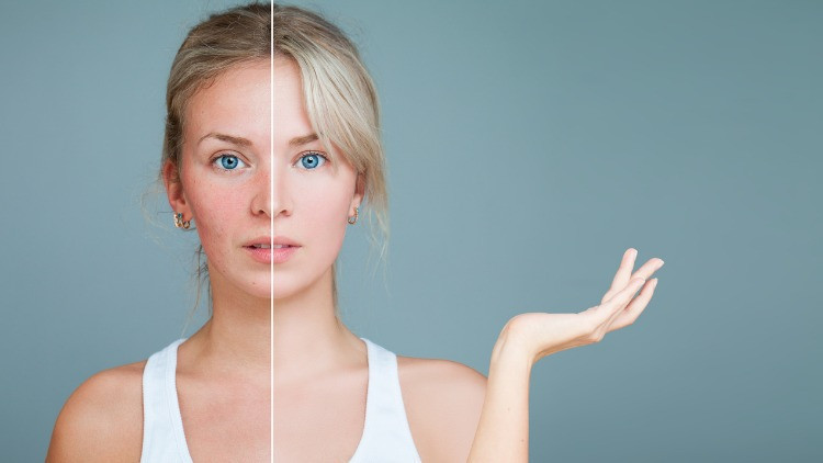 GÖZ ALTI TORBALARININ AMELİYATSIZ LAZER İLE TEDAVİSİNİN AVANTAJLARI ÜSTÜNLÜKLERİ NELERDİR