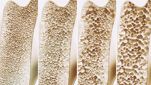 Güçlü kemiklerin sırrı Bu vitamin ve minerallerle dost olun