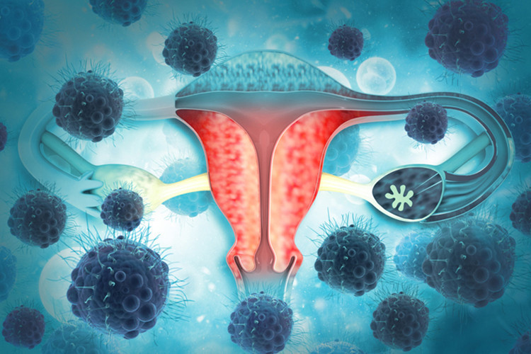 Endometriozis nedir Endometriozis nedir