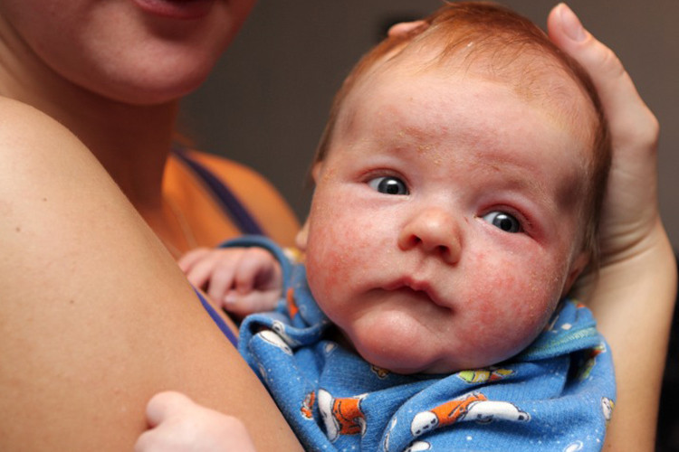 Besin alerjisi nedir