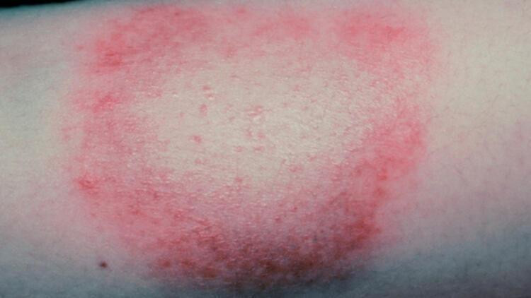 Lyme hastalığı nedir, belirtileri neler İşte Lyme hastalığının belirtileri ve tedavisi hakkında bilgiler