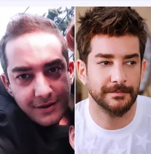 Enis Arıkandan estetik itirafı