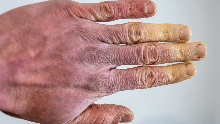 Raynaud fenomeni (Reyno hastalığı) belirtileri nelerdir, neden olur? Reyno hastalığı tedavi yöntemleri - Hürriyet Aile