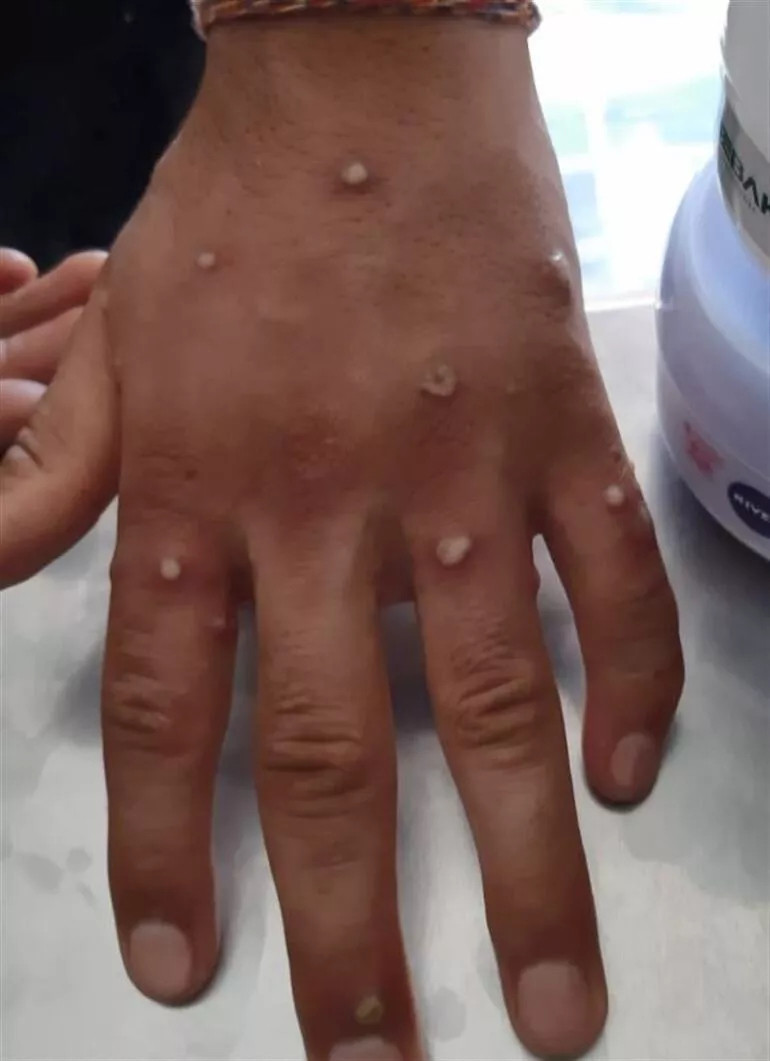 Sultangazide Maymun çiçeği  hareketliliği