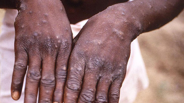 MAYMUN ÇİÇEĞİ BELİRTİLERİ NELERDİR