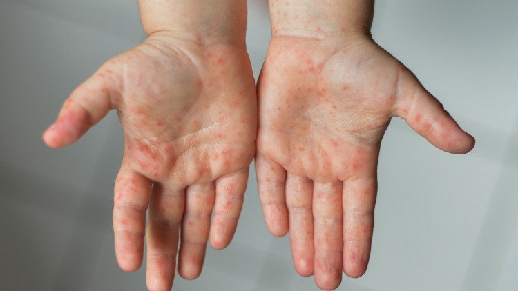 Domates gribi nedir, belirtileri neler Domates gribi bulaşıcı mı, aşısı var mı İşte domates gribi hakkında merak edilenler Domates gribi nedir, belirtileri neler Domates gribi bulaşıcı mı, aşısı var mı İşte domates gribi hakkında merak edilenler