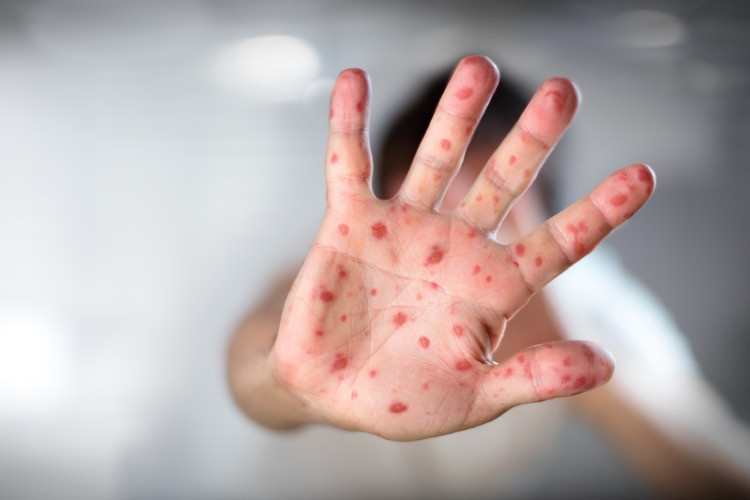 DOMATES GRİBİ BULAŞICI MI DOMATES GRİBİ BULAŞICI MI