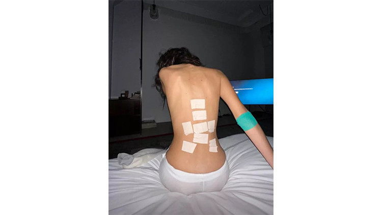 Lyme hastalığı nedir Lyme hastalığı nedir