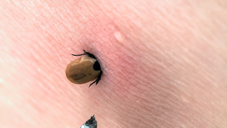 Lyme hastalığı tedavisi Lyme hastalığı tedavisi
