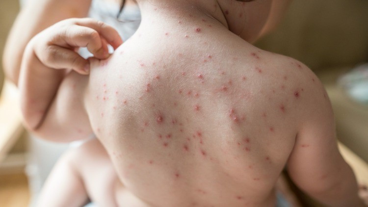 Suçiçeği nedir Suçiçeği nedir