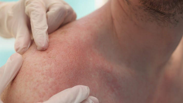 Anafilaktik şok nedir, nasıl anlaşılır Bu bulgular hayati önem taşıyor Uzmanı anlattı... İşte Anafilaktik şok belirtileri ve tedavisi