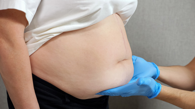 Pek çok hastalığın temelinde o yatıyor Obezite cerrahisi kimler için uygun